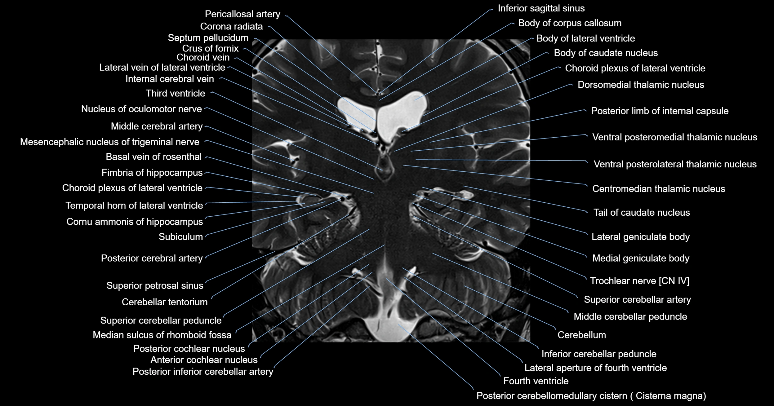 MRI brainstem & basal ganglia anatomy labelled 3T MRI images -img-00001-00026.webp